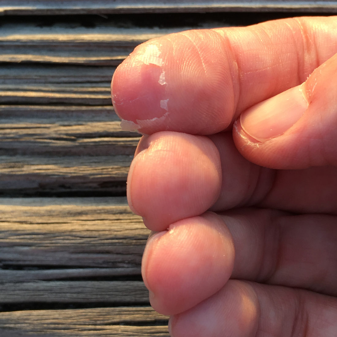 Closeup of frostbitten fingers