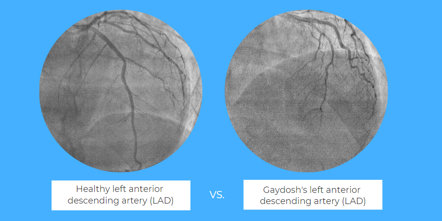 Side-by-side comparison of a healthy left anterior descending artery and an unhealthy one