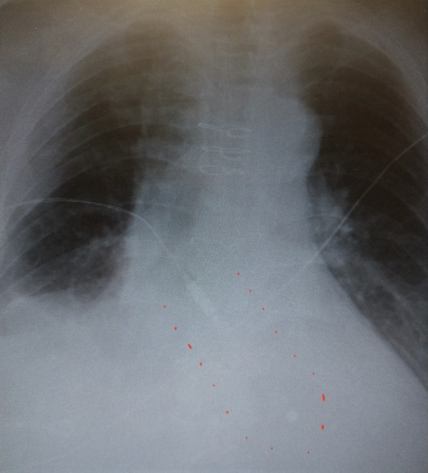 Chest x-ray showing heart pump