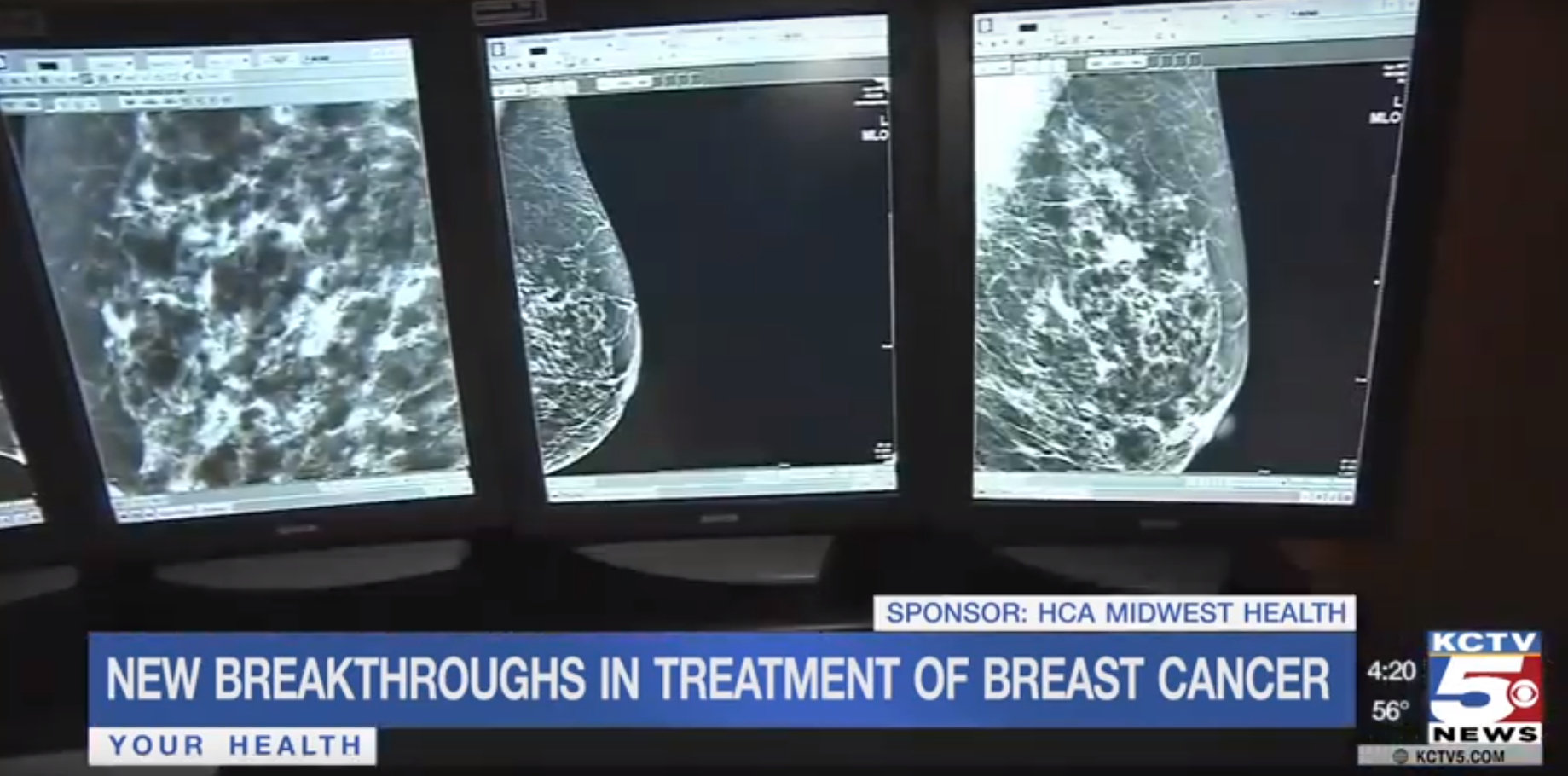 A news segment about breast cancer showing mammogram images